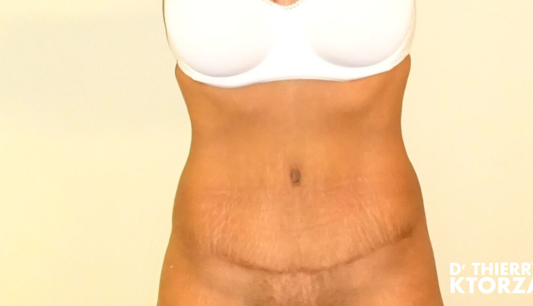 Les cicatrices après une abdominoplastie