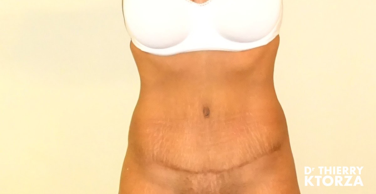 abdominoplastie-cicatrices
