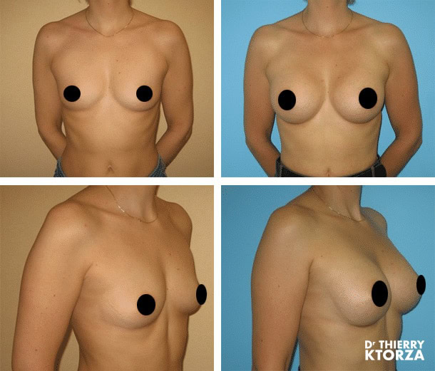 Implants mammaires : existe-t-il une alternative ?