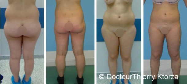 alternatives-liposuccion