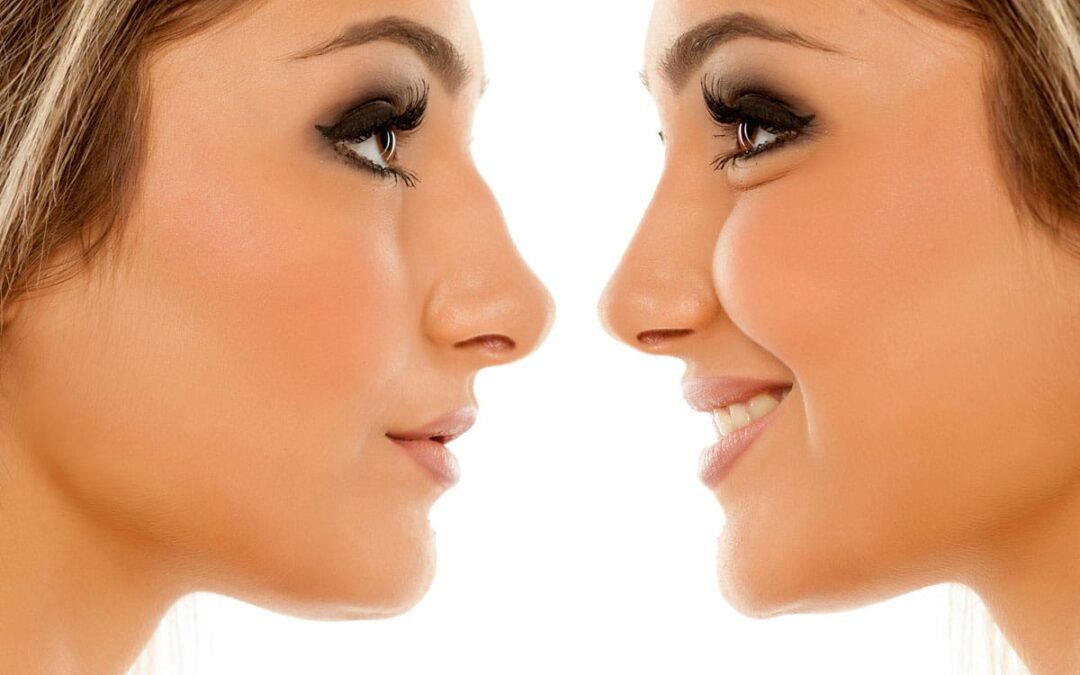Quel est le prix d’une rhinoplastie ?