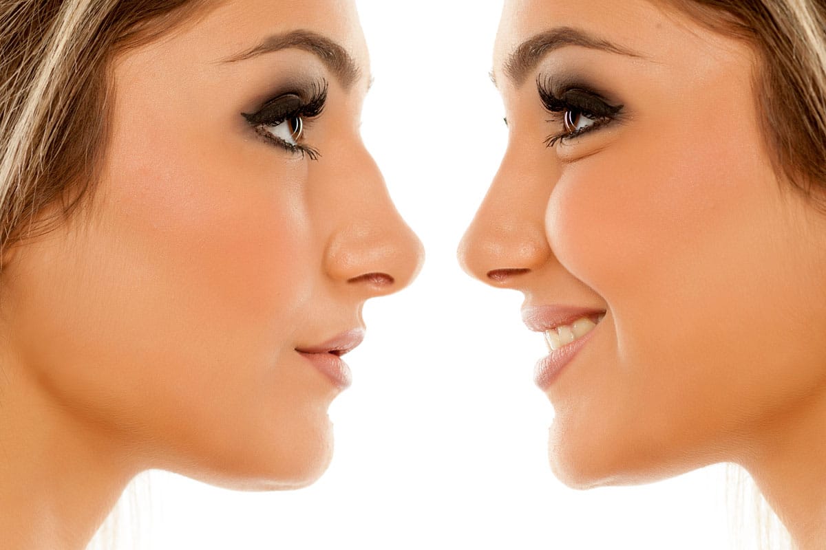 chirurgie-esthetique-rhinoplastie