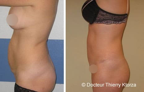 |ventre-plat-liposuccion| |ventre-plat-liposuccion|