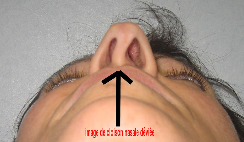 cloison-nasale-deviee-solutions