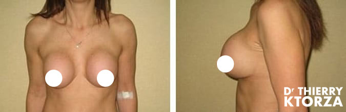 |coque-retrait-apres-pose-implants |coque-retrait-apres-pose-implants