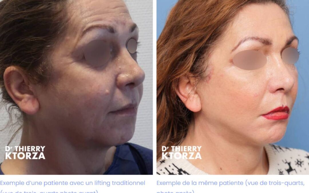 Différence entre lifting et fils tenseurs : quelle technique choisir pour rajeunir votre visage ?