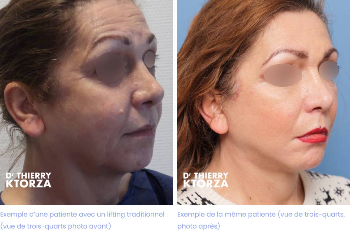 difference lifting fils tenseurs|lifting avant|lifting apres|pose fils tenseeurs avant|pose fils tenseurs apres|fils tenseur vs lifting difference lifting fils tenseurs|lifting avant|lifting apres|pose fils tenseeurs avant|pose fils tenseurs apres|fils tenseur vs lifting