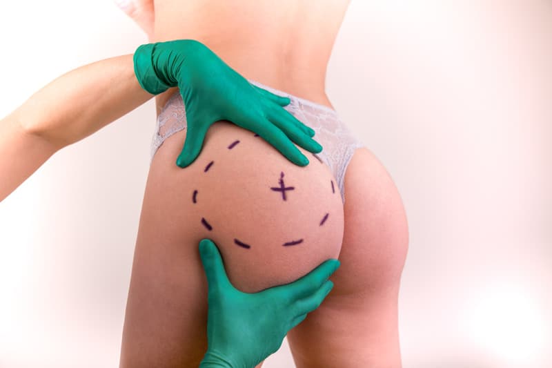 hyacorp-macrolane-difference-pour-gonfler-fesses