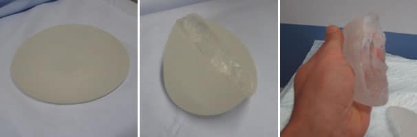Le point sur les implants mammaires PIP