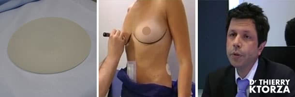 Quelle est la durée de vie des implants mammaires ?
