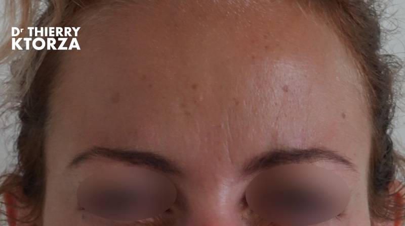 Botox efficace contre les rides d'expression (photo après)|injection botox avant|Botox Traitement anti-âge non chirurgical (photo après)|Botox efficace contre les rides d'expression (photo avant) Botox efficace contre les rides d'expression (photo après)|injection botox avant|Botox Traitement anti-âge non chirurgical (photo après)|Botox efficace contre les rides d'expression (photo avant)