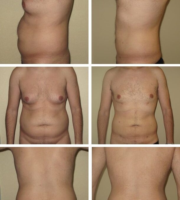 La liposuccion est-elle efficace chez les hommes ?