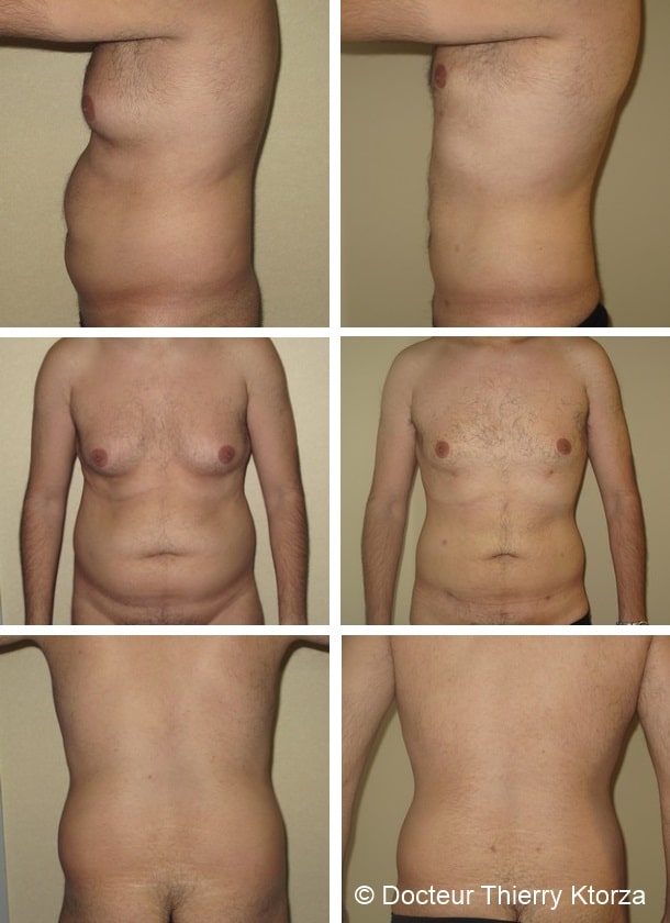 liposuccion-homme-docteur-ktorza liposuccion-homme-docteur-ktorza