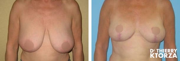 Comment corriger les seins qui tombent sans cicatrices ?