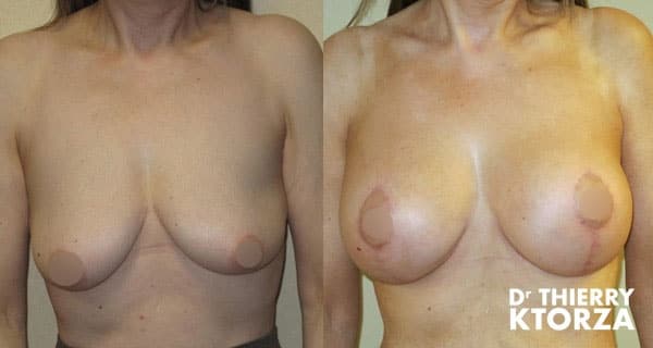 |ptose-mammaire-remonter-seins-tombants