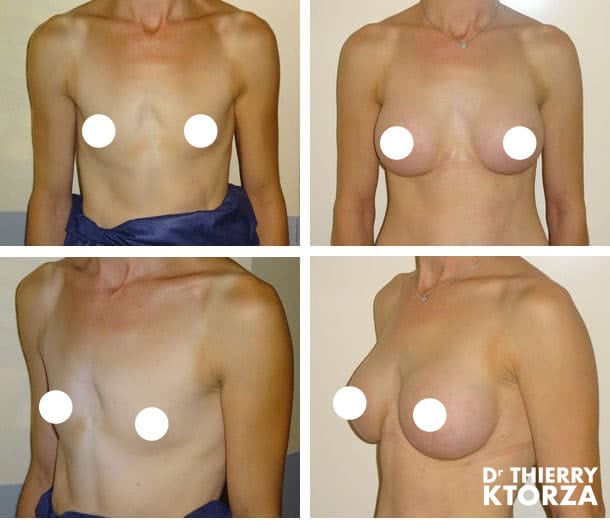 |chirurgie-mammaire-securite-sociale||| |chirurgie-mammaire-securite-sociale|||