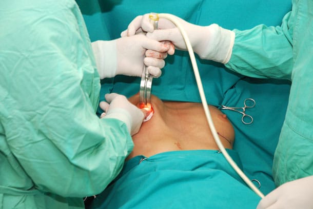 Devenir des seins après un retrait des implants mammaires