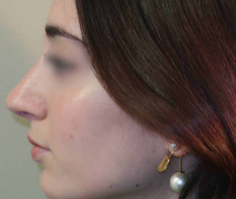 Existe t-il un âge idéal pour faire une rhinoplastie ?