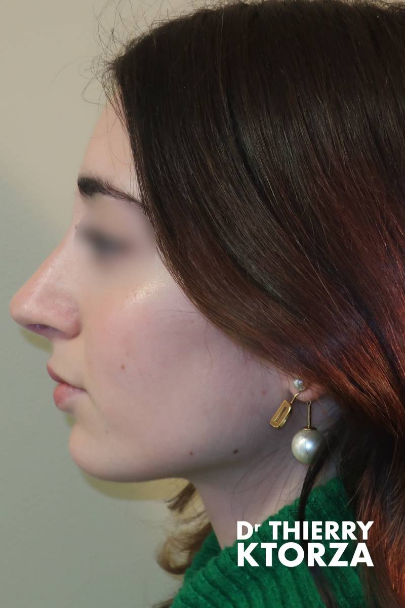 rhinoplastie adolescente apres|rhinoplastie adolescente avant|rhinoplastie adulte avant|rhinoplastie adulte apres|rhinoplastie senior avant|rhinoplastie senior apres rhinoplastie adolescente apres|rhinoplastie adolescente avant|rhinoplastie adulte avant|rhinoplastie adulte apres|rhinoplastie senior avant|rhinoplastie senior apres