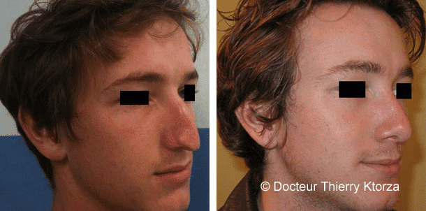 rhinoplastie-avant-apres-jeune-homme-nez-pointu|