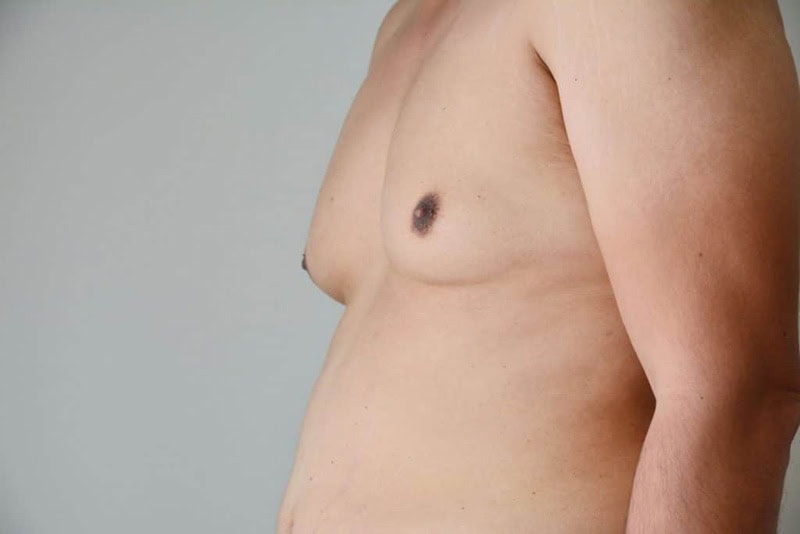 Les seins chez les hommes : les solutions