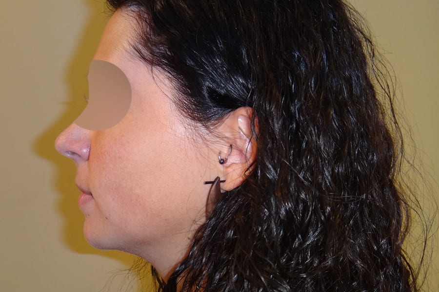 genioplastie chirurgie menton dr thierry ktorza chirurgien esthetique visage paris apres 1 genioplastie chirurgie menton dr thierry ktorza chirurgien esthetique visage paris apres 1