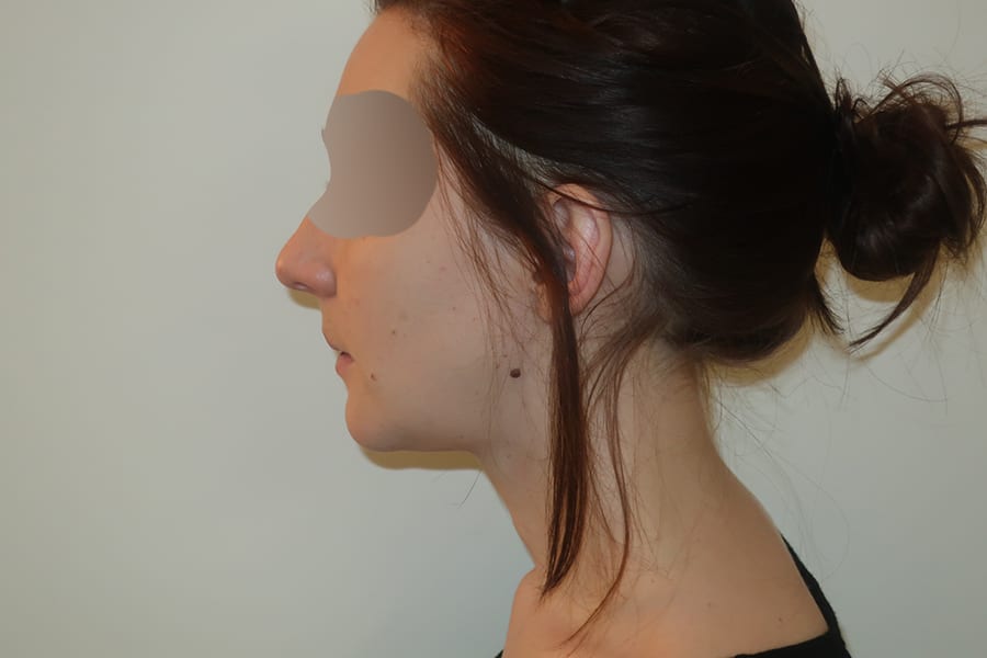 genioplastie chirurgie menton dr thierry ktorza chirurgien esthetique visage paris apres 2 genioplastie chirurgie menton dr thierry ktorza chirurgien esthetique visage paris apres 2
