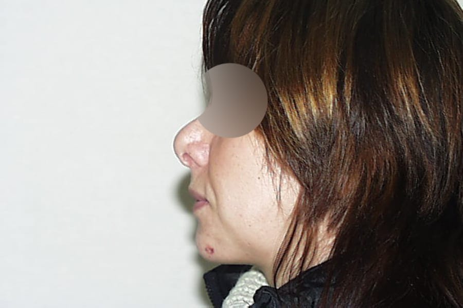 genioplastie chirurgie menton dr thierry ktorza chirurgien esthetique visage paris apres 3 genioplastie chirurgie menton dr thierry ktorza chirurgien esthetique visage paris apres 3