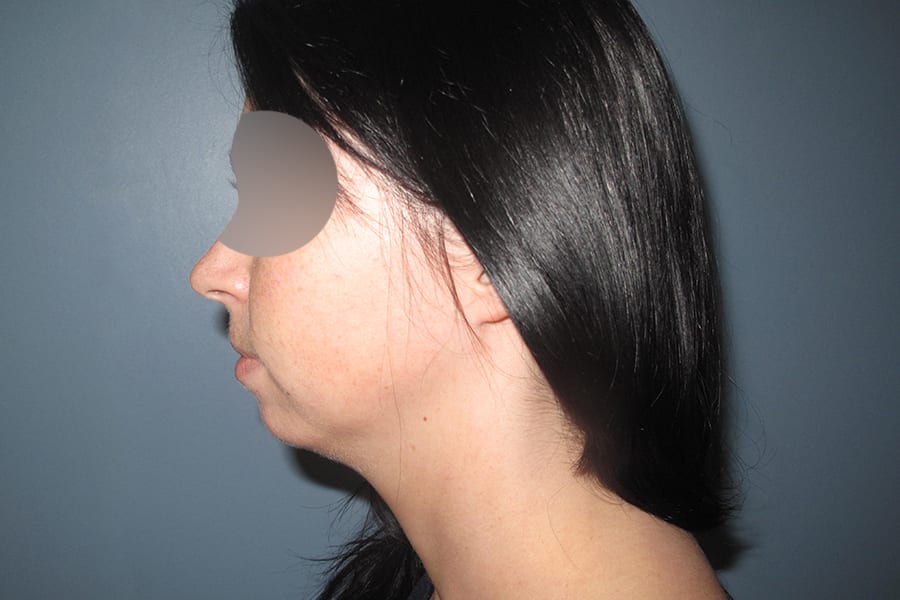 genioplastie chirurgie menton dr thierry ktorza chirurgien esthetique visage paris avant 1 genioplastie chirurgie menton dr thierry ktorza chirurgien esthetique visage paris avant 1