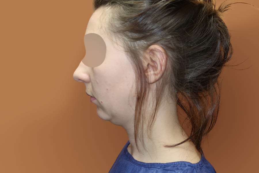 genioplastie chirurgie menton dr thierry ktorza chirurgien esthetique visage paris avant 2 genioplastie chirurgie menton dr thierry ktorza chirurgien esthetique visage paris avant 2
