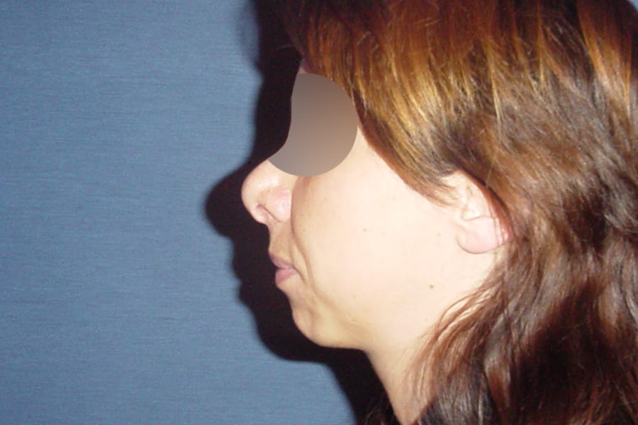 genioplastie chirurgie menton dr thierry ktorza chirurgien esthetique visage paris avant 3 genioplastie chirurgie menton dr thierry ktorza chirurgien esthetique visage paris avant 3